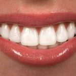 روکش ایمپلنت دندان چیست؟