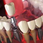 ایمپلنت دندان یک روزه یا فوری