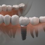 علت لق شدن ایمپلنت دندان چیست؟