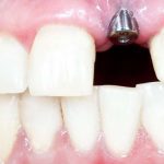 مزایای ایمپلنت دندان فوری