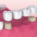 کاشت دندان بدون ایمپلنت به چه صورت انجام می شود؟
