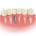 انواع روش های کاشت دندان طبیعی و کاربرد آن