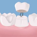 علت افتادن روکش ایمپلنت دندان