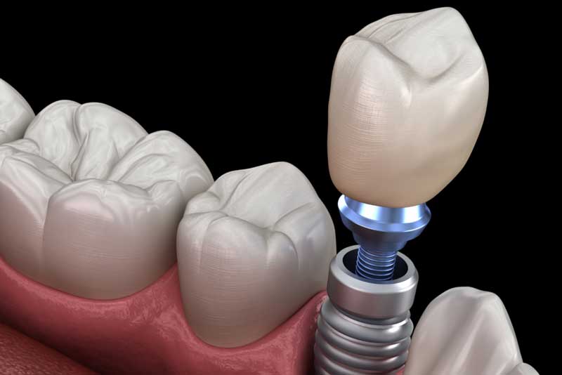 تفاوت ایمپلنت دندان با روکش دندان