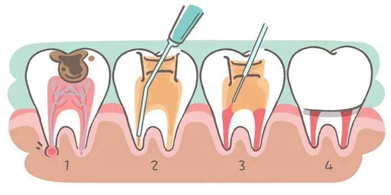 فاکتورهای اصلی بر هزینه درمان ریشه دندان
