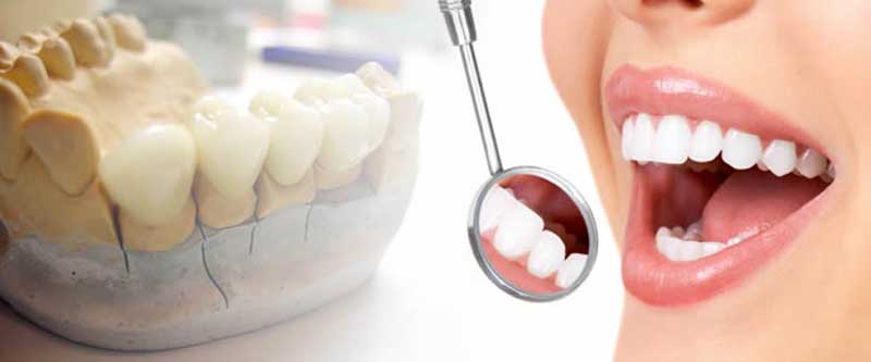 هزینه پروتز دندان