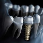 ایمپلنت دندان ارزان کجا انجام می شود؟