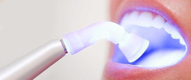 ایمپلنت دندان با لیزر