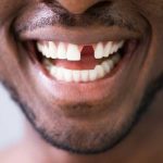 ایمپلنت دندان با پانچ به چه صورت است؟