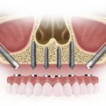 ایمپلنت دندان زایگما (Zygomatic) چیست؟