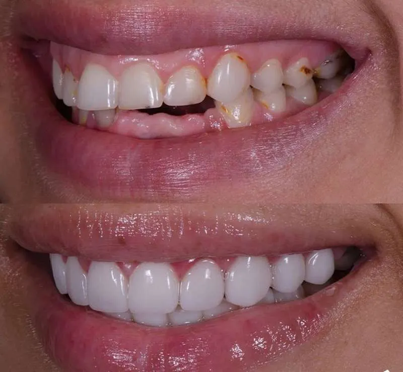ایمپلنت دندان زایگما چگونه عمل می کند؟