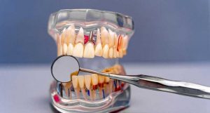 ایمپلنت دندان در بلوار مدیریت
