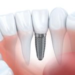 ایمپلنت دندان 4
