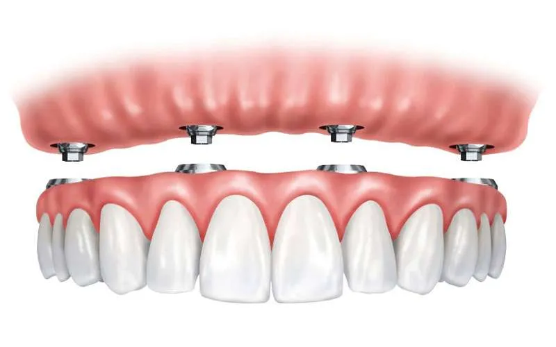 ایمپلنت دندان 4 چیست؟