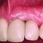 ایمپلنت دندان 6