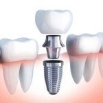 ایمپلنت دندان 5 چیست و چگونه انجام می شود؟