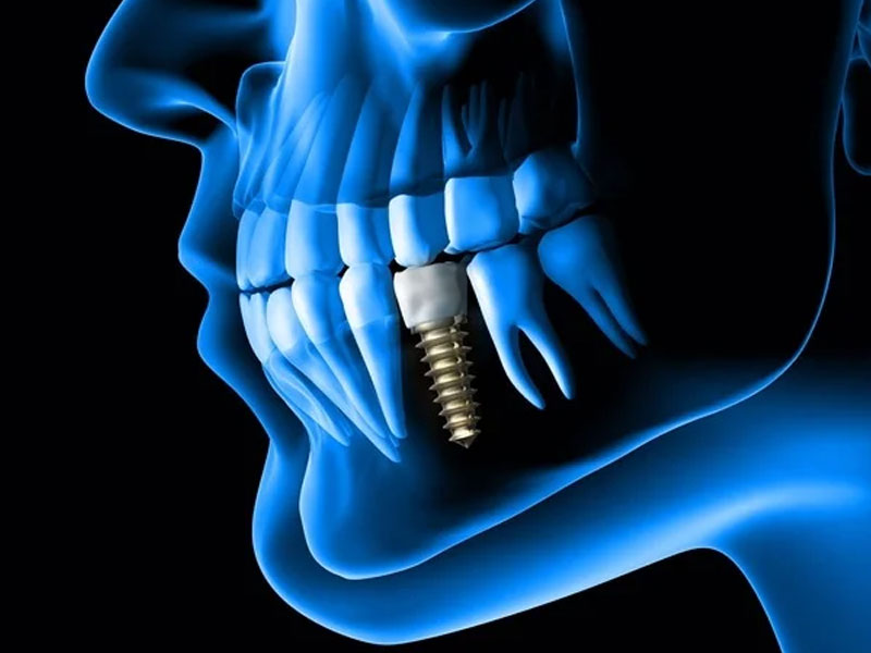 مراحل کاشت ایمپلنت دندان نوبل بیوکر