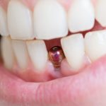 کاشت دندان تکی چیست و انواع آن کدام است؟