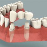 کاشت دندان پروتز چیست و هزینه کاشت چقدر است؟