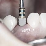 ایمپلنت دندان بدون برش لثه چیست؟
