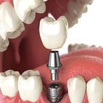 تفاوت متخصص ایمپلنت با دندانپزشک در چیست؟