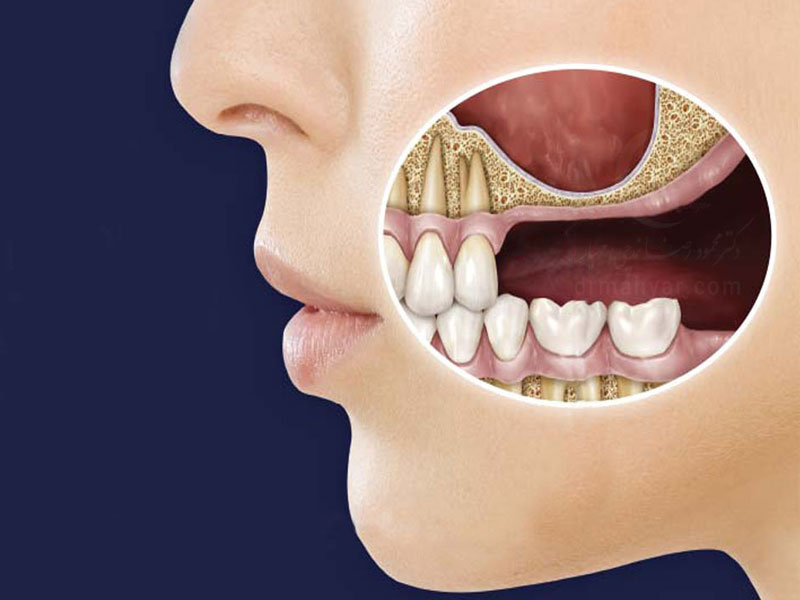 سینوس دندان چیست؟