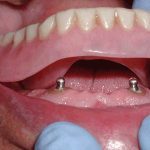 ایمپلنت با دندان مصنوعی چیست؟