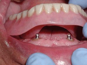 ایمپلنت با دندان مصنوعی