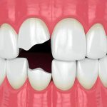 ایمپلنت دندان شکسته چیست؟