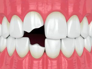 ایمپلنت دندان شکسته چیست