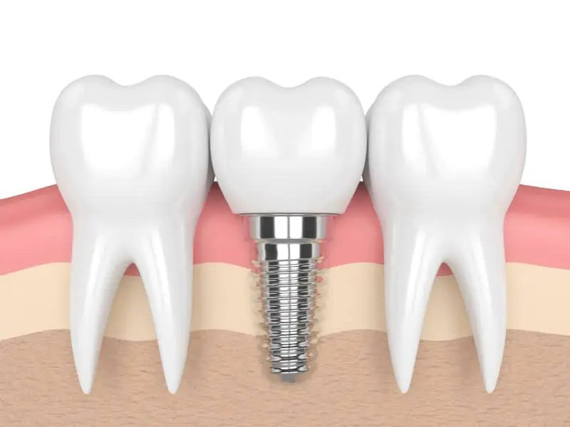 ایمپلنت دندان برای چه افرادی مناسب است؟
