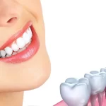 ایمپلنت دندان چند جلسه طول میکشد؟