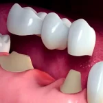 کاشت دندان بریج چیست؟