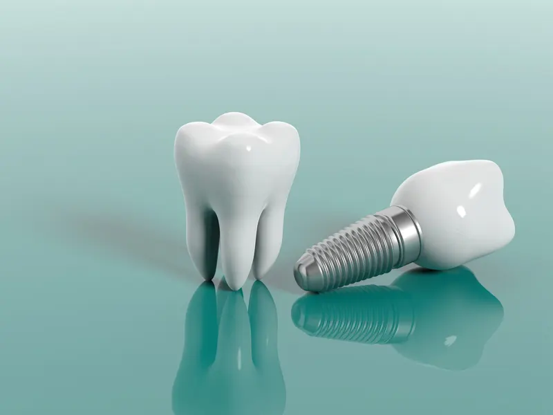 چرا ایمپلنت، کاشت دائمی دندان است؟