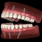 کاشت دندان فلزی