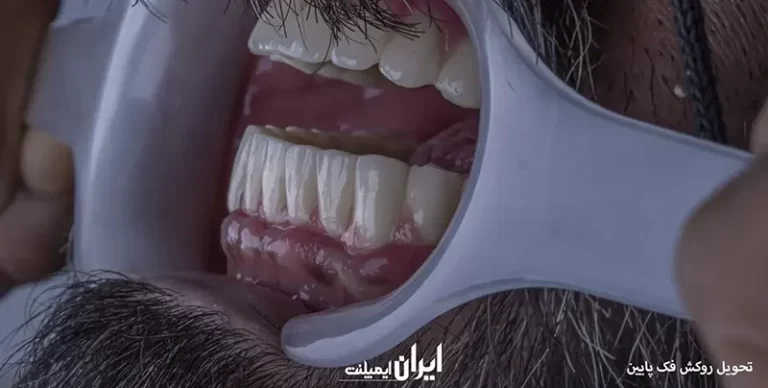 نمونه کارهای ایمپلنت دندان در سعادت آباد