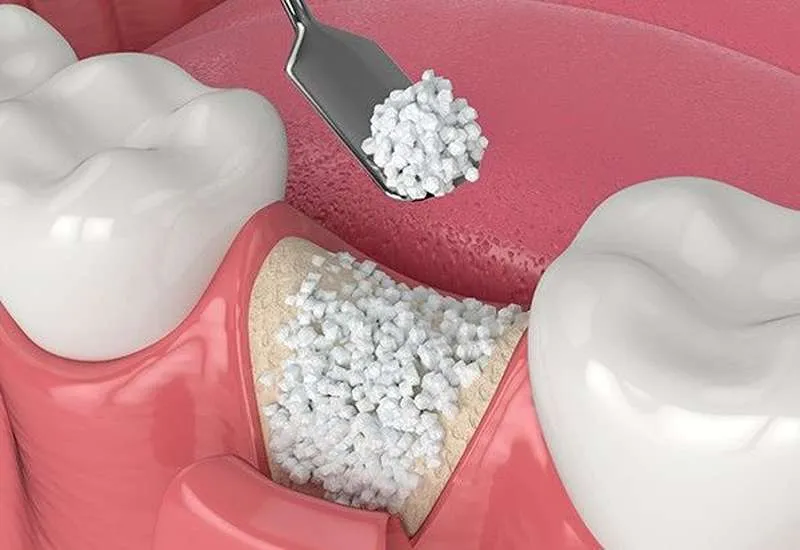پودر استخوان چیست و چه کاربردی در ایمپلنت دندان دارد؟