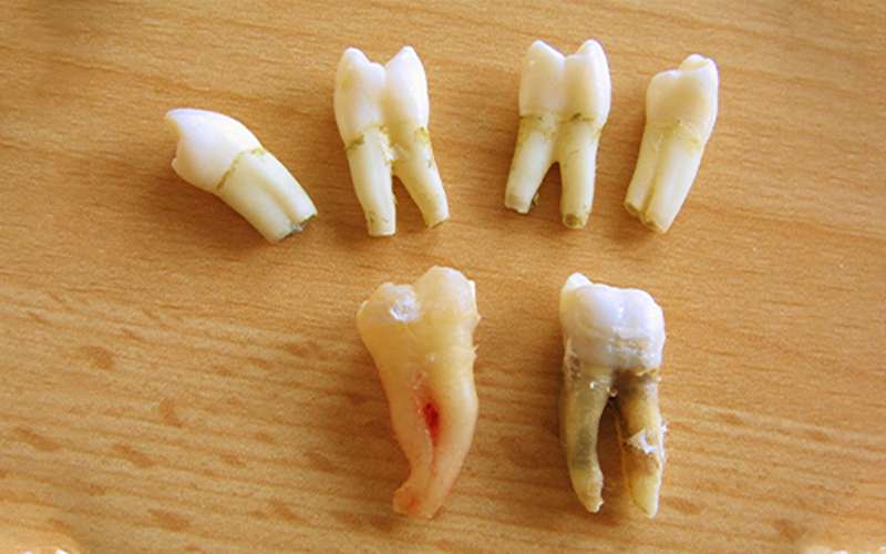 اگر در دندان عقل حفره داشته باشید چه اتفاقی می افتد؟
