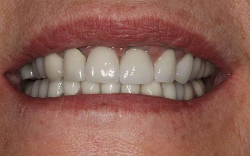 کیفیت ایمپلنت دندان
