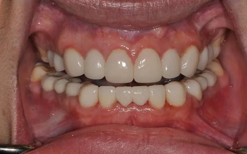 بعد ایمپلنت دندان 