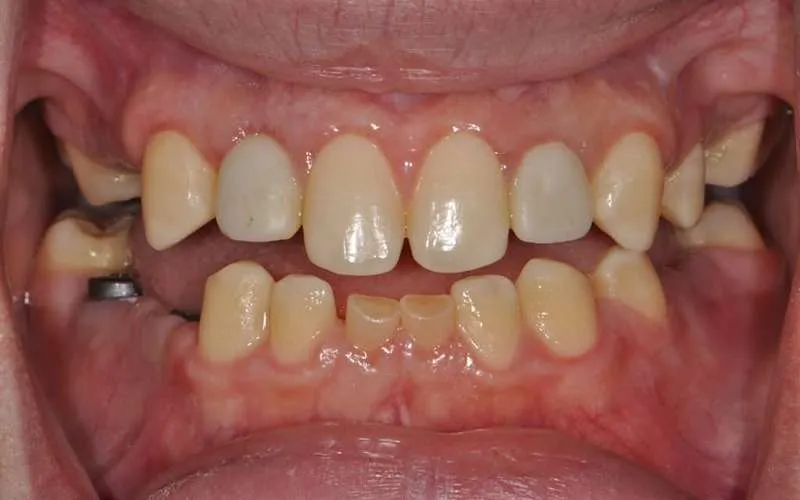 عکس قبل ایمپلنت دندان 
