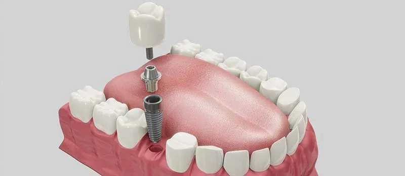 عمر انواع ایمپلنت دندان
