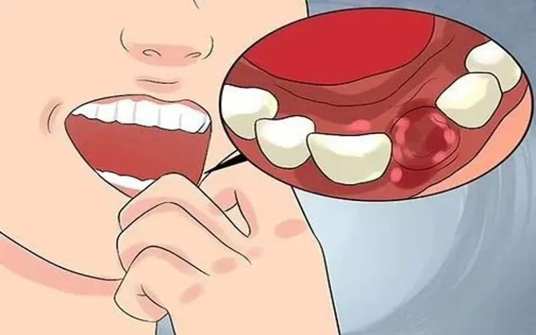 جلوگیری از عفونت و ورم جراحی دندان عقل