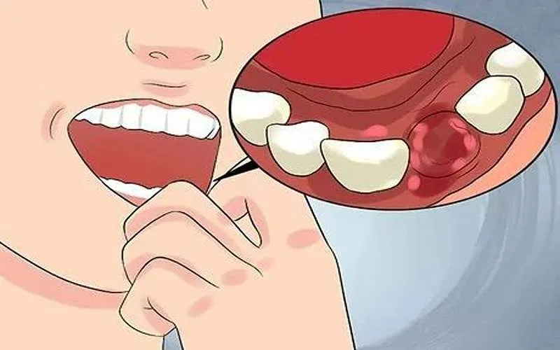 جلوگیری از عفونت و ورم جراحی دندان عقل
