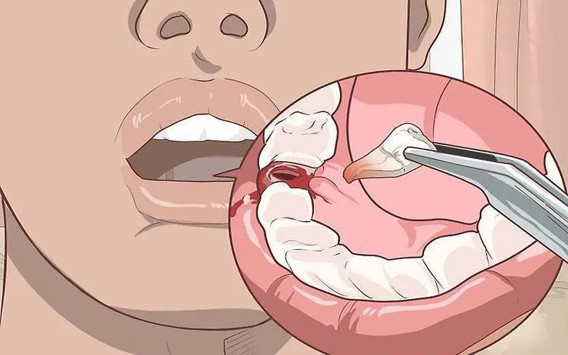 چه زمانی کشیدن دندان عقل نیاز به آنتی بیوتیک دارد