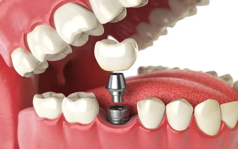 پوکی استخوان چگونه روی ایمپلنت دندان تاثیر می گذارد؟